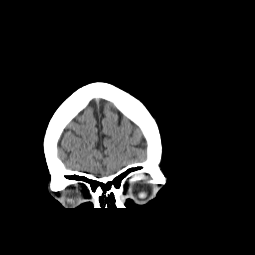 File:Cerebellar infarct due to vertebral artery dissection with posterior fossa decompression (Radiopaedia 82779-97029 Coronal non-contrast 6).png