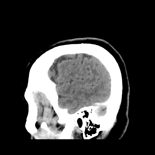 Cerebellar metastasis (cystic appearance) (Radiopaedia 41395-44258 F 10).png