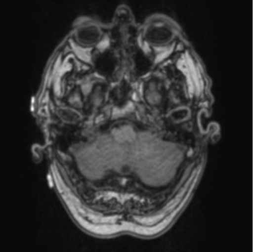 Cerebellar metastasis from lung adenocarcinoma (Radiopaedia 86690-102829 Axial T1 17).png