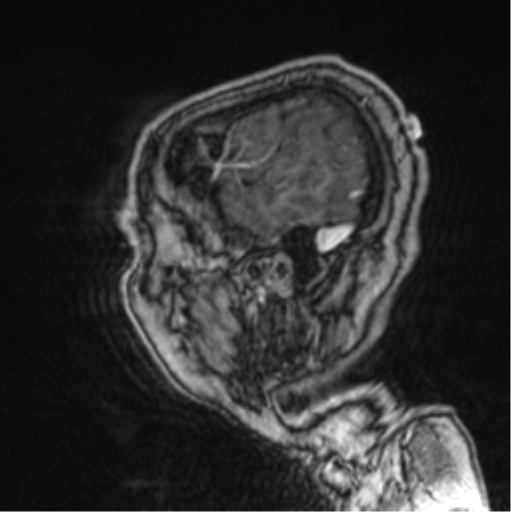 Cerebellar metastasis from lung adenocarcinoma (Radiopaedia 86690-102829 Sagittal T1 C+ 71).png