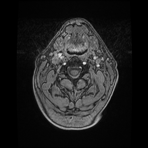 Cerebellar metastasis of pulmonary adenocarcinoma, cavernous venous malformation, and developmental venous anomaly (Radiopaedia 85827-101661 Axial T1 C+ 1).jpg