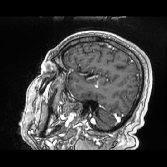 Cerebellar metastasis of pulmonary adenocarcinoma, cavernous venous malformation, and developmental venous anomaly (Radiopaedia 85827-101661 Sagittal T1 C+ 73).jpg