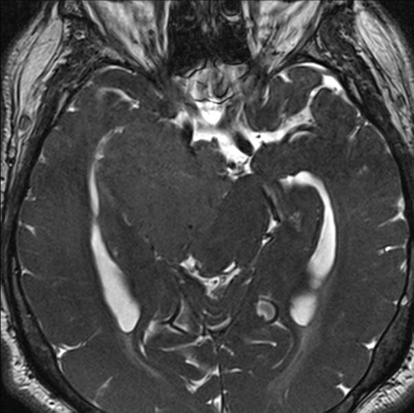 Cerebellopontine angle meningioma (Radiopaedia 24459-24764 I 39).jpg