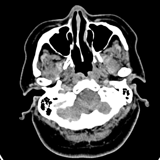 Cerebellopontine angle meningioma (Radiopaedia 35181-36714 A 49).jpg