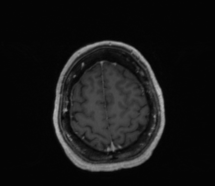 Cerebellopontine angle meningioma (Radiopaedia 35181-36715 Axial T1 C+ 12).jpg