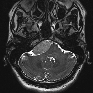 Cerebellopontine angle meningioma (Radiopaedia 72983-83680 Axial FIESTA 19).jpg