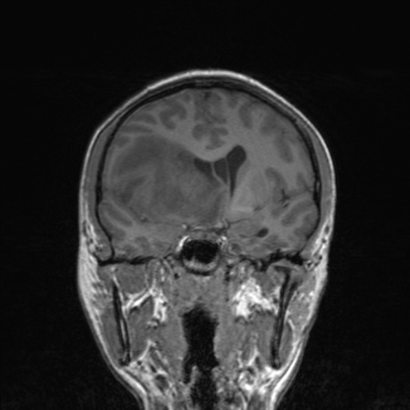 File:Cerebral abscess (Radiopaedia 24212-24478 Coronal T1 98).jpg