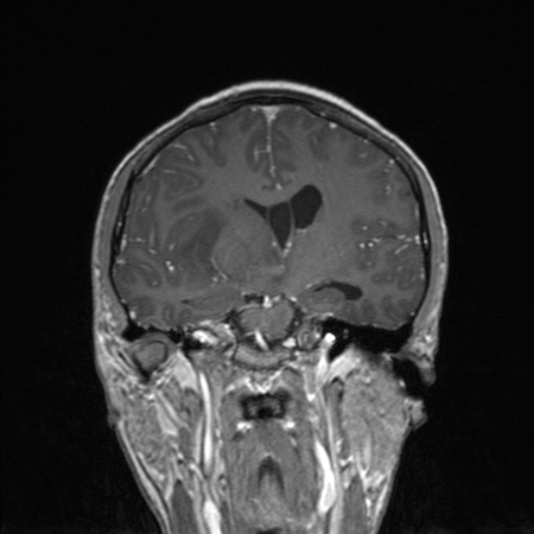 Cerebral abscess (Radiopaedia 24212-24478 Coronal T1 C+ 109).jpg