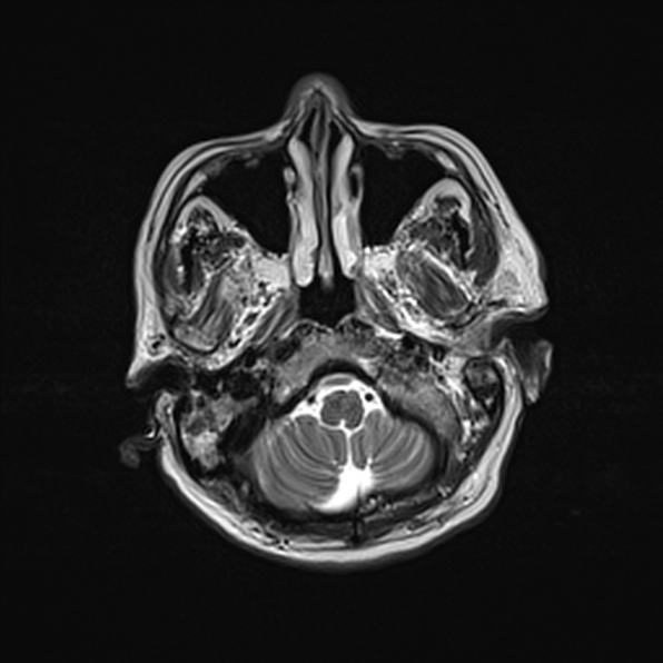 Cerebral abscess (Radiopaedia 26111-26247 Axial T2 13).jpg