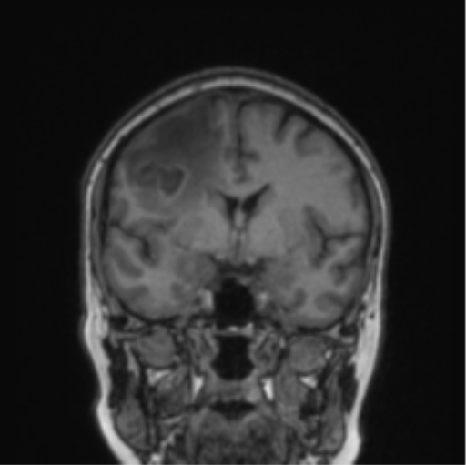 Cerebral abscess from pulmonary arteriovenous malformation (Radiopaedia 86275-102291 Coronal T1 53).png