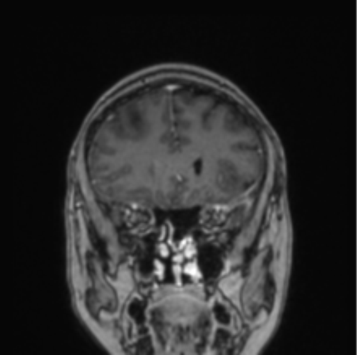 Cerebral abscess from pulmonary arteriovenous malformation (Radiopaedia 86275-102291 L 65).png