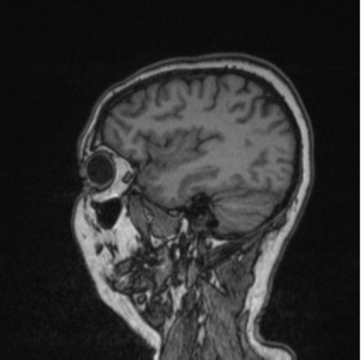 Cerebral abscess from pulmonary arteriovenous malformation (Radiopaedia 86275-102291 Sagittal T1 35).png