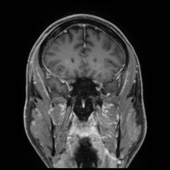 Cerebral abscess with ventriculitis (Radiopaedia 78965-91878 Coronal T1 C+ 22).jpg