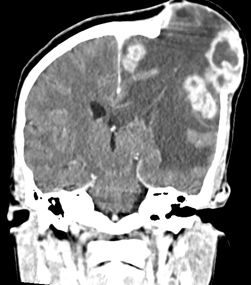 Cerebral abscesses (Radiopaedia 70458-80568 Coronal Contrast 38).jpg