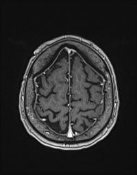 Cerebral amyloid angiopathy-related inflammation (Radiopaedia 58270-65377 Axial T1 C+ fat sat 126).jpg