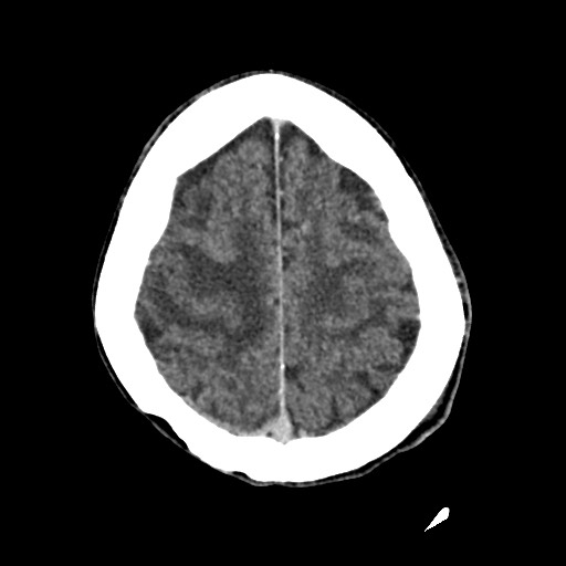 Cerebral amyloid angiopathy-related inflammation (Radiopaedia 74836-85848 Axial non-contrast 49).jpg