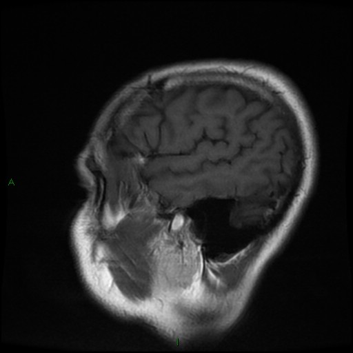 File:Cerebral amyloid angiopathy (Radiopaedia 77506-89664 Coronal T1 5).jpg