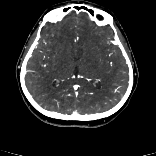 Cerebral arteriovenous malformation (Radiopaedia 73830-84645 Axial C+ delayed 46).jpg