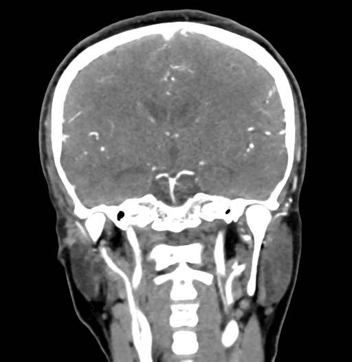 File:Cerebral arteriovenous malformation (Radiopaedia 73830-84645 C 51).jpg