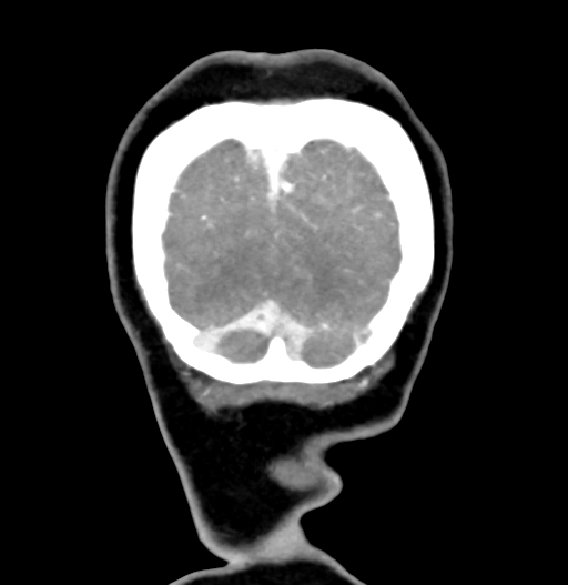 Cerebral arteriovenous malformation (Radiopaedia 73830-84645 C 90).jpg