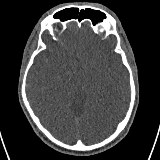 File:Cerebral arteriovenous malformation (Radiopaedia 78188-90746 Axial non-contrast 76).jpg