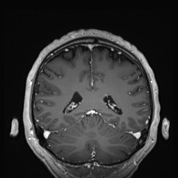 Cerebral arteriovenous malformation (Radiopaedia 84015-99245 Coronal T1 C+ 113).jpg