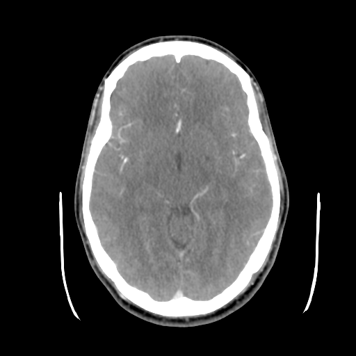 Cerebral arteriovenous malformation (Spetzler-Martin grade 2) (Radiopaedia 41262-44076 Axial C+ 23).png