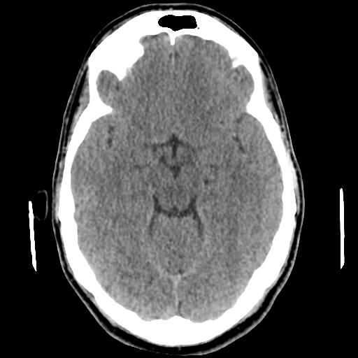 Cerebral arteriovenous malformation (Spetzler-Martin grade 2) (Radiopaedia 41262-44076 Axial non-contrast 23).png
