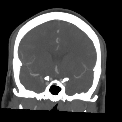 Cerebral arteriovenous malformation (Spetzler-Martin grade 2) (Radiopaedia 41262-44076 F 25).png