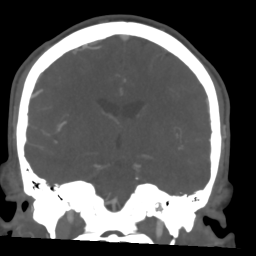 Cerebral arteriovenous malformation (Spetzler-Martin grade 2) (Radiopaedia 41262-44076 F 33).png