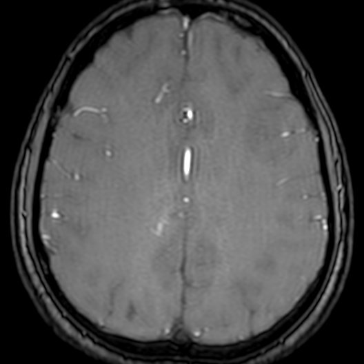 Cerebral arteriovenous malformation at posterior body of corpus callosum (Radiopaedia 74111-84925 Axial MRA 153).jpg