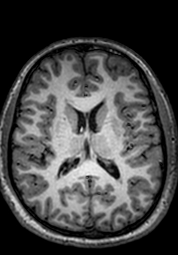 Cerebral arteriovenous malformation at posterior body of corpus callosum (Radiopaedia 74111-84925 Axial T1 123).jpg