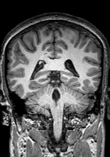 Cerebral arteriovenous malformation at posterior body of corpus callosum (Radiopaedia 74111-84925 Coronal T1 223).jpg