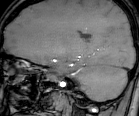 Cerebral arteriovenous malformation at posterior body of corpus callosum (Radiopaedia 74111-84925 J 139).jpg
