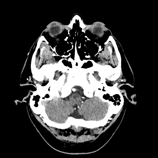 Cerebral arteriovenous malformation with lobar hemorrhage (Radiopaedia 35598-57216 A 9).jpg
