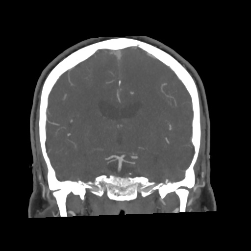 Cerebral arteriovenous malformation with lobar hemorrhage (Radiopaedia 35598-57216 C 48).jpg