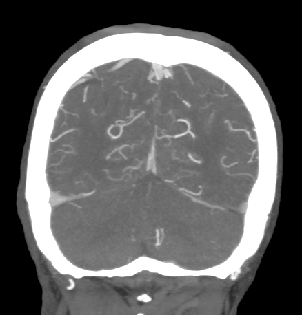 File:Cerebral arteriovenous malformation with lobar hemorrhage (Radiopaedia 44725-48511 B 46).png
