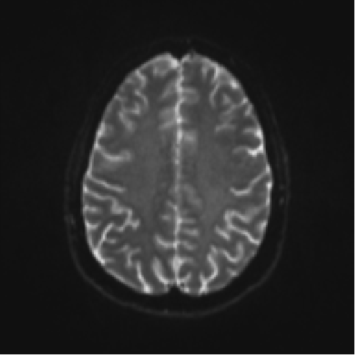 File:Cerebral cavernoma and development venous anomaly (Radiopaedia 37603-39482 Axial DWI 16).png