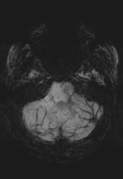 File:Cerebral cavernoma and development venous anomaly (Radiopaedia 37603-39482 Axial SWI MIP 9).png