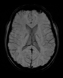 Cerebral cavernous venous malformation (Radiopaedia 70008-80021 Axial SWI 39).jpg
