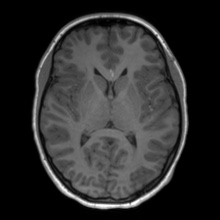Cerebral cavernous venous malformation (Radiopaedia 70008-80021 Axial T1 40).jpg