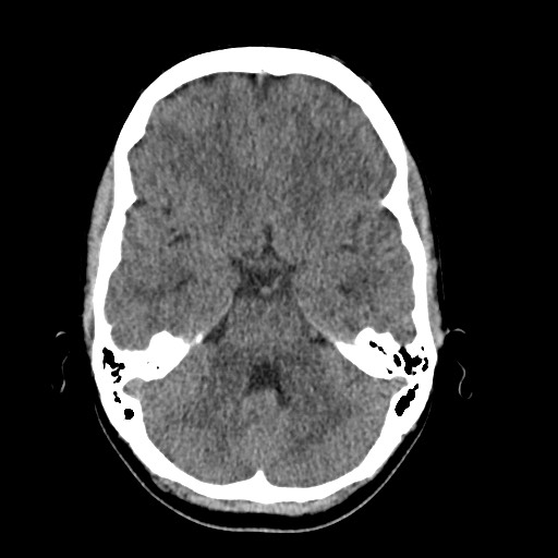 File:Cerebral cavernous venous malformation (Radiopaedia 70008-80022 Axial non-contrast 15).jpg