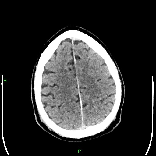Cerebral contusions (Radiopaedia 33868-35039 Axial non-contrast 170).jpg