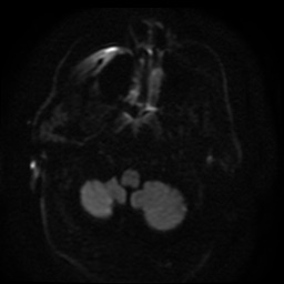 Cerebral embolic infarcts (embolic shower) (Radiopaedia 49837-55108 Axial DWI 92).jpg