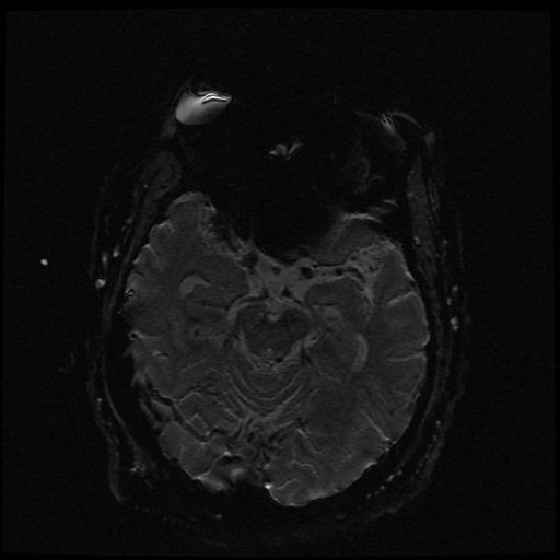 Cerebral embolic infarcts (embolic shower) (Radiopaedia 49837-55108 Axial SWI 47).jpg