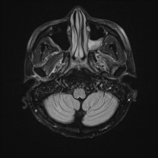 File:Cerebral embolic infarcts (embolic shower) (Radiopaedia 72391-82921 Axial FLAIR 5).jpg