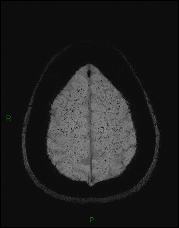 Cerebral fat embolism (Radiopaedia 35022-36525 Axial SWI 52).jpg