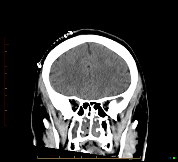 Cerebral fat embolism (Radiopaedia 85521-101224 Coronal non-contrast 20).jpg