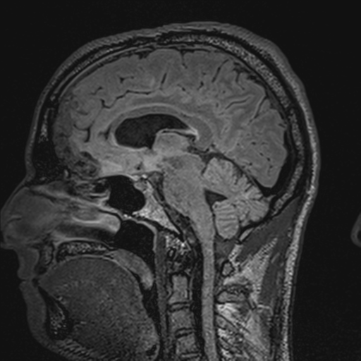 File:Cerebral hemorrhagic contusions- temporal evolution (Radiopaedia 40224-42757 Sagittal T1 43).png