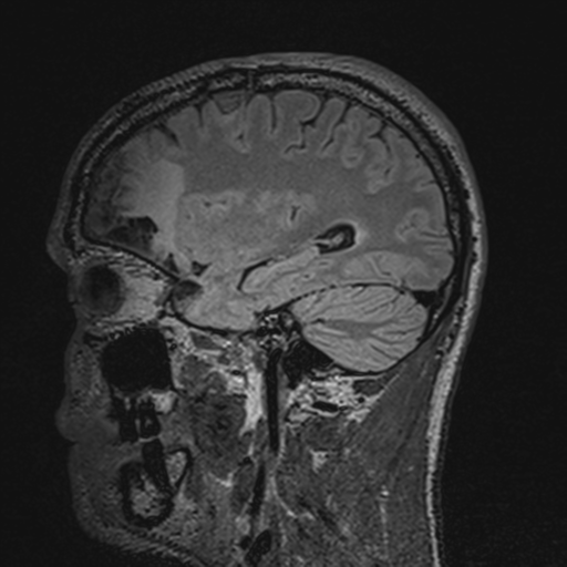 File:Cerebral hemorrhagic contusions- temporal evolution (Radiopaedia 40224-42757 Sagittal T1 56).png